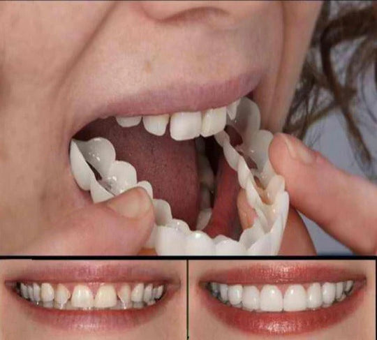 Fitflex Opzet Gebit